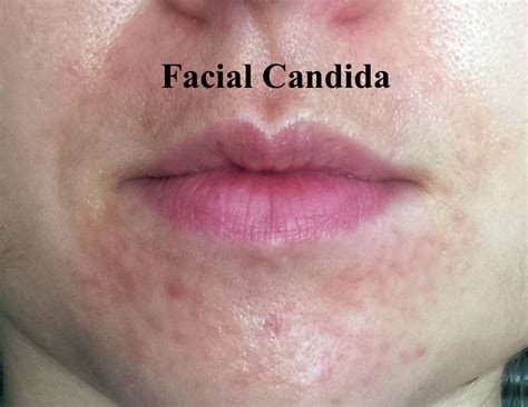 Candida Of The Skin Facial Yeast And How It Can Occur Lea Advanced