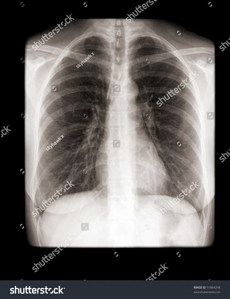 There is a degree of hyperinflation as evidenced by both increased retrosternal airspace and somewhat flattened and depressed diaphragms. Human Chest Normal Lungs On Xray Stock Photo 51884248 ...
