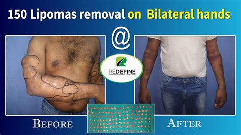 Multiple Lipomas Removal Redefine Plastic Surgery Centre Dr Hari