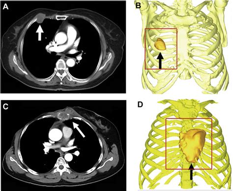 A Preoperative Chest Computed Tomography Ct Image Of A Patient With