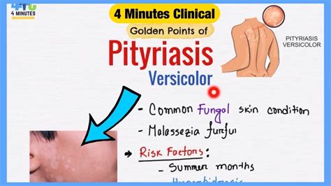 Pityriasis Versicolor Explained Like Water Symptoms Pathogenesis