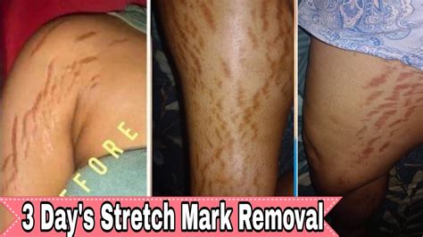 Stretch Mark Removal How To Remove Stretch Mark Using Baking Soda