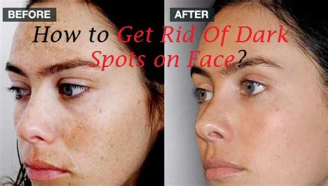 Get Rid Of Dark Spots On Face