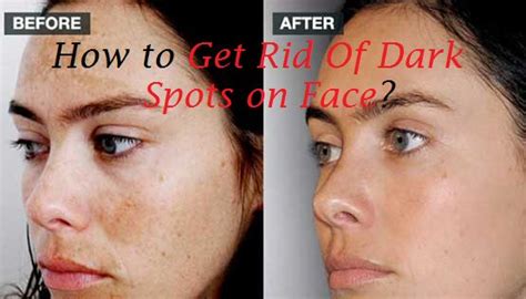 If you have sensitive skin, start by diluting the lemon juice with an equal amount of water. How to Get Rid of Dark Spots on Face?