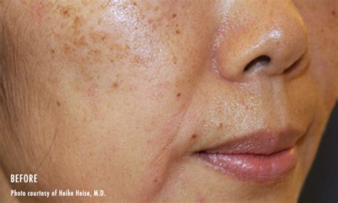 Pico Genesis Facial Rejuvenation Perth Mira Clinic