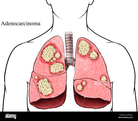 Adenocarcinoma Lung Hi Res Stock Photography And Images Alamy