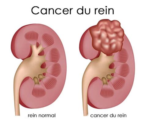Cancer Du Rein Et Tumeur Du Rein Dr Bron Urologue
