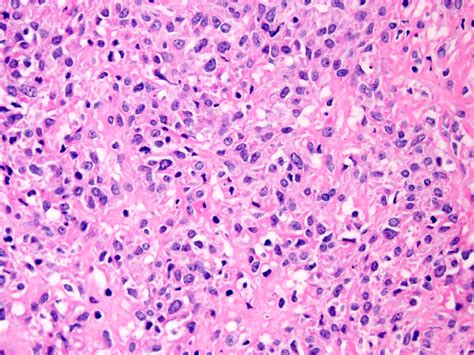 Pathology Outlines Sclerosing Epithelioid Fibrosarcoma