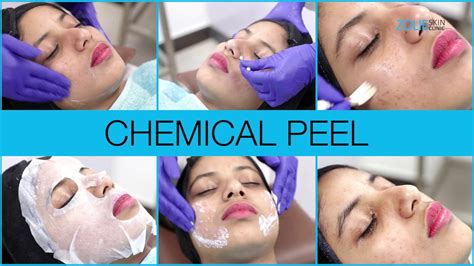 Chemical Peel Chemical Peel For Acne Chemical Peel Before After