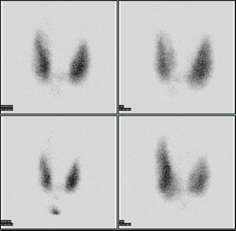 Thyroid Scan With Technetium 99m Answers On Healthtap