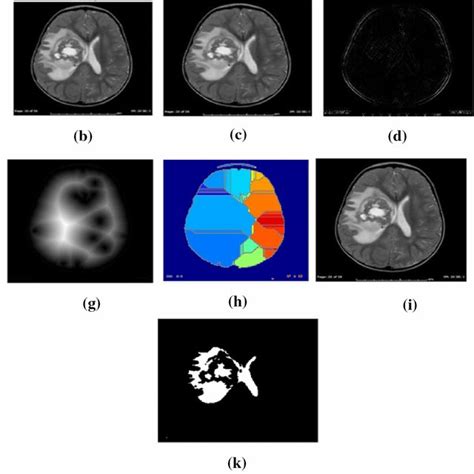 Simulation Result Of Benign Brain Tumor Image A Tumor Affected Mri