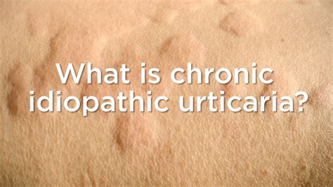 Chronic Idiopathic Urticaria Living With Itchy Hives That Never Go