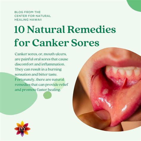 Homeopathic Remedy For Canker Sores 10 Mouth Ulcer Remedies Dr Diana Joy Ostroff