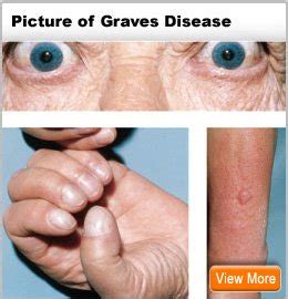 Feb 26, 2020 · graves' disease this is the most common cause of hyperthyroidism and has an autoimmune basis. Graves Disease Rheumatoid Factor