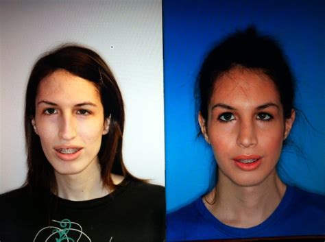 Before And After Pictures Of Jaw Surgery Oral Surgery Boca And Delray