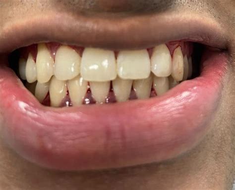 5 Top Dental Tips For Healthy Gums Nyc Dentist Manhattan