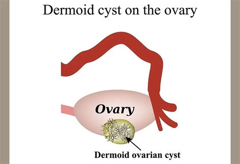 Dermoid Cyst Types Reasons Signs And Treatment