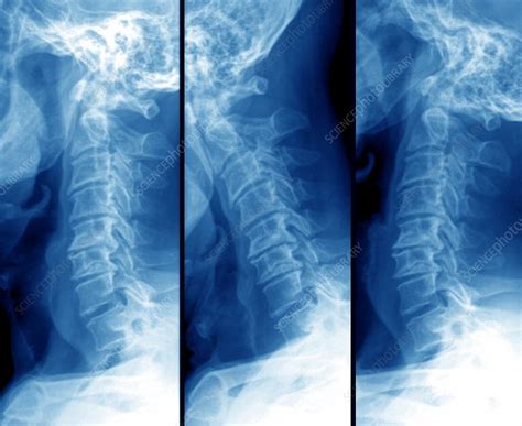 Arthritis Of The Neck Bones X Ray Stock Image C0096767 Science