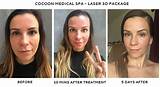 Recovery Time Co2 Laser Skin Resurfacing Pictures