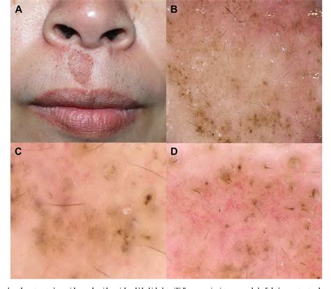 Figure 1 From Successful Treatment Of Superficial Basal Cell Carcinoma