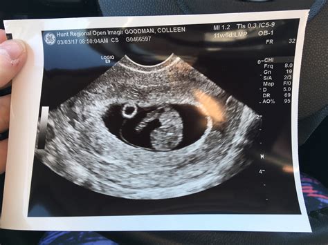 8 Weeks Pregnant Ultrasound