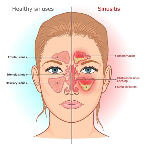 Sinusitis Infection Vector Illustration Stock Vector Illustration Of