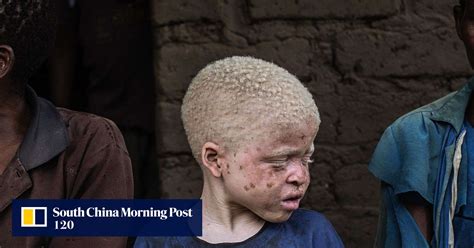 Albinos In Malawi Being Hunted For Their Body Parts For Witchcraft On The Rise Says Amnesty