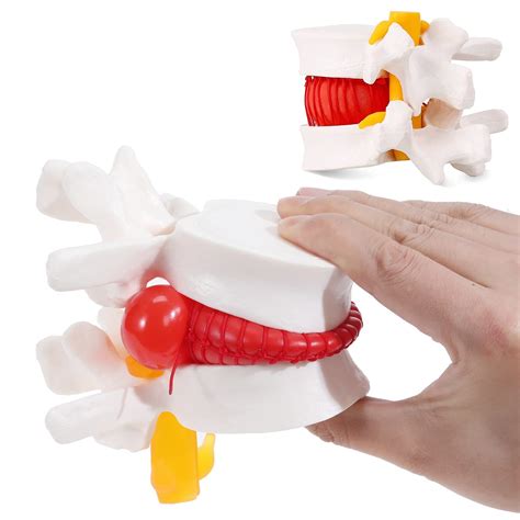 Buy ASINTOD Human Anatomy Lumbar Disc Herniation Model A Model Showing