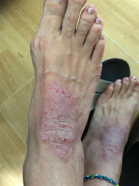 Foot Eczema Healing In 2 Weeks What Allergy Blog