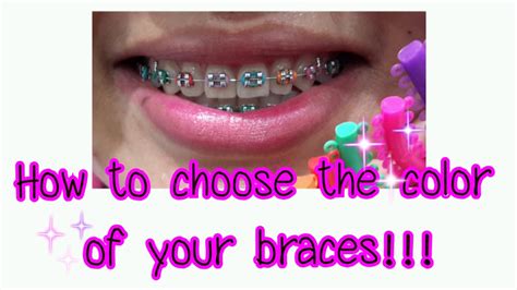 When you smile with colored braces that complement your eye it is usually a good idea to avoid bright white braces, as it will only make your teeth look dull. How to choose the color of your braces!!! - YouTube
