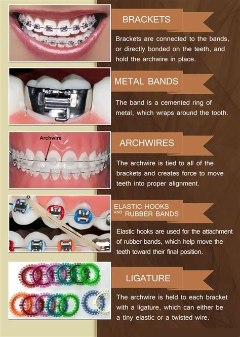 I Like How Well They Describe The Braces Parts Along With The Pictures