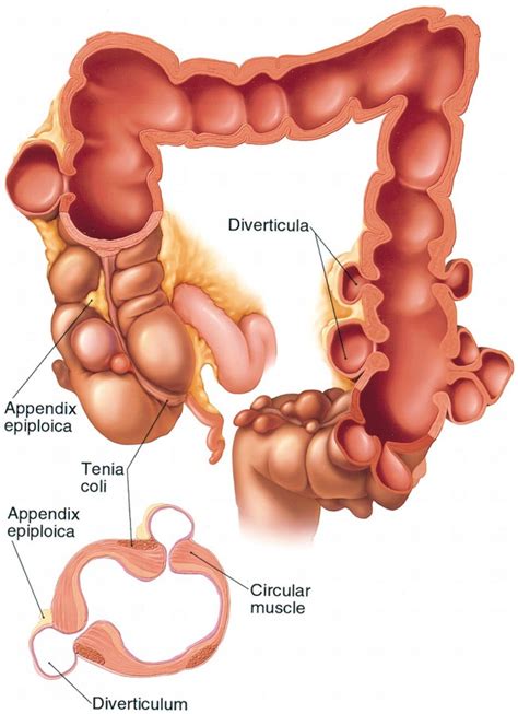 Colon Diverticulosis Overview Dr Anastasios Christodoulou