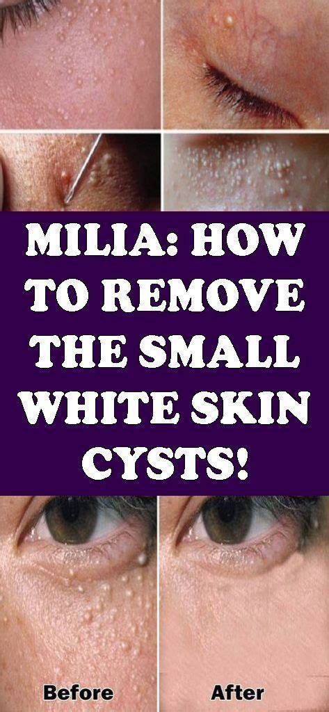 Milia How To Remove The Small White Skin Cysts Whiter Skin Skin