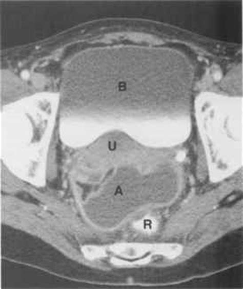 Organs may show no change in early stages. The Spread and Localization of Intraperitoneal Abscesses ...