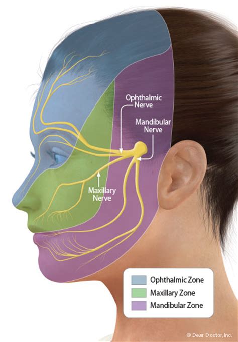 Trigeminal Neuralgia A Nerve Disorder That Causes Facial Pain