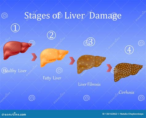 What Are The Stages Of Cirrhosis Of The Liver Cation