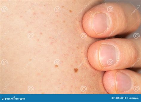 Close Up Of Keratosis Pilaris On The Arm Of A Young Caucasian Man Stock