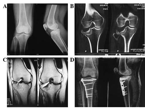 Mdct And Mri For The Diagnosis Of Complex Fractures Of The Tibial