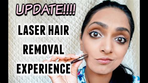 My Experience With Laser Hair Removal For Dark Skin Update Deepica