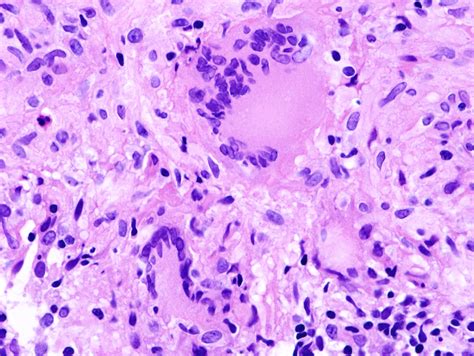 Multinucleated Giant Cells Langhan Cells In Tb Biopsy Also Shows