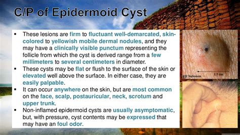 Cutaneous Cysts