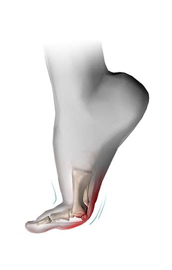 Big Toe Joint Conditions Ottawa Foot Clinic