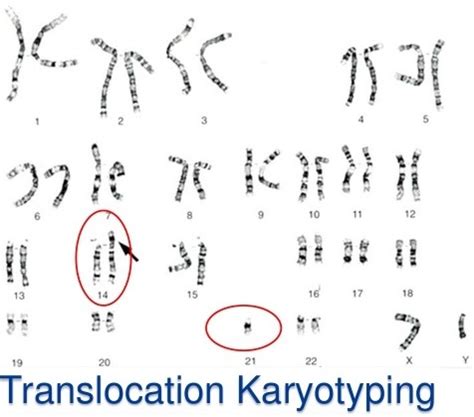 Another genetic test called fish. Down Syndrome Karyotypes Explained Crystal Clear | New Health Advisor