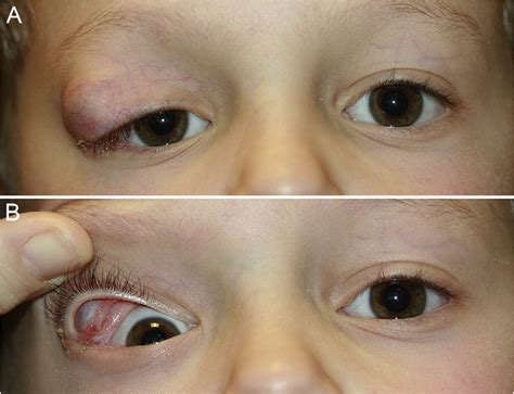 Developmental Conjunctival Cyst Of The Eyelid In A Child Semantic