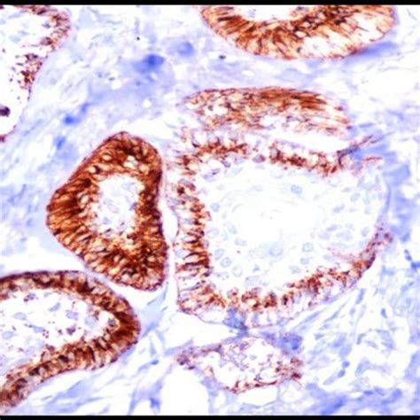 Immunohistochemically Stained Section Of Inflamed Dentigerous Cyst