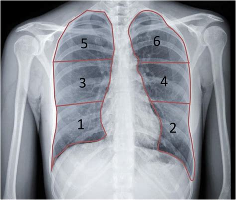 Chest X Ray Quality Normal Chest X Ray Lung Zones Vrogue Co