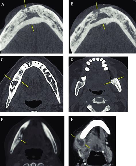 A B Mandibular Osteoradionecrosis Axial Ct Images Showing Extensive