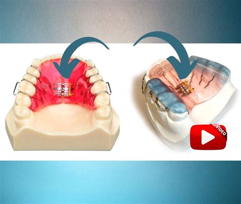 Cómo activar los aparatos removibles de ortodopedia y ortodoncia interceptiva OdontoVida