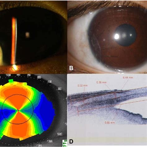 A A 18 Year Old Boy With A Limbal Dermoid At The Inferotemporal Region