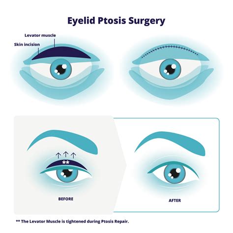Droopy Eyelids Ptosis Asia Retina Singapore
